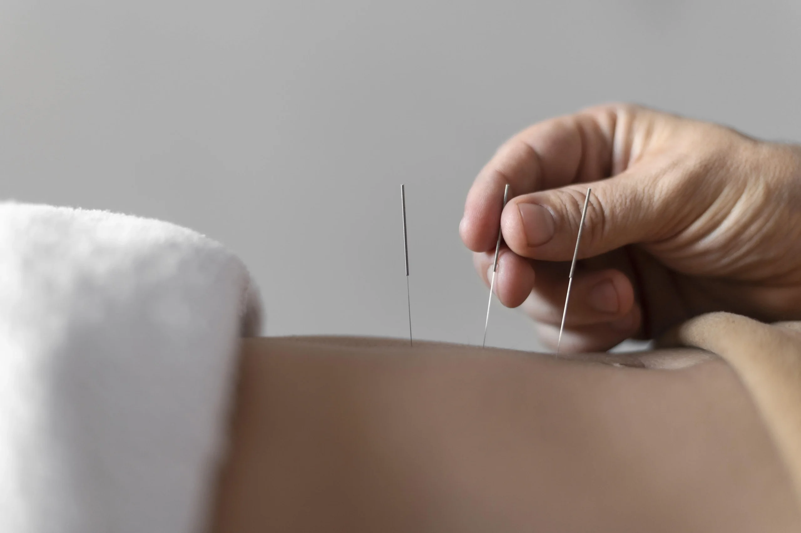 Finding a Qualified Acupuncturist