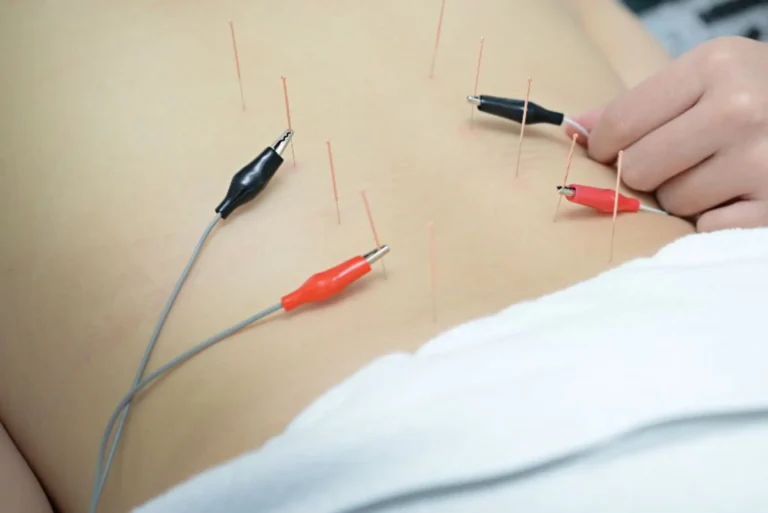Benefits of Acupuncture Therapy